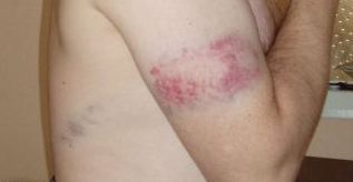 bruises